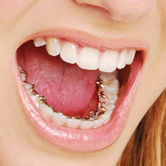 Ortodontia Lingual